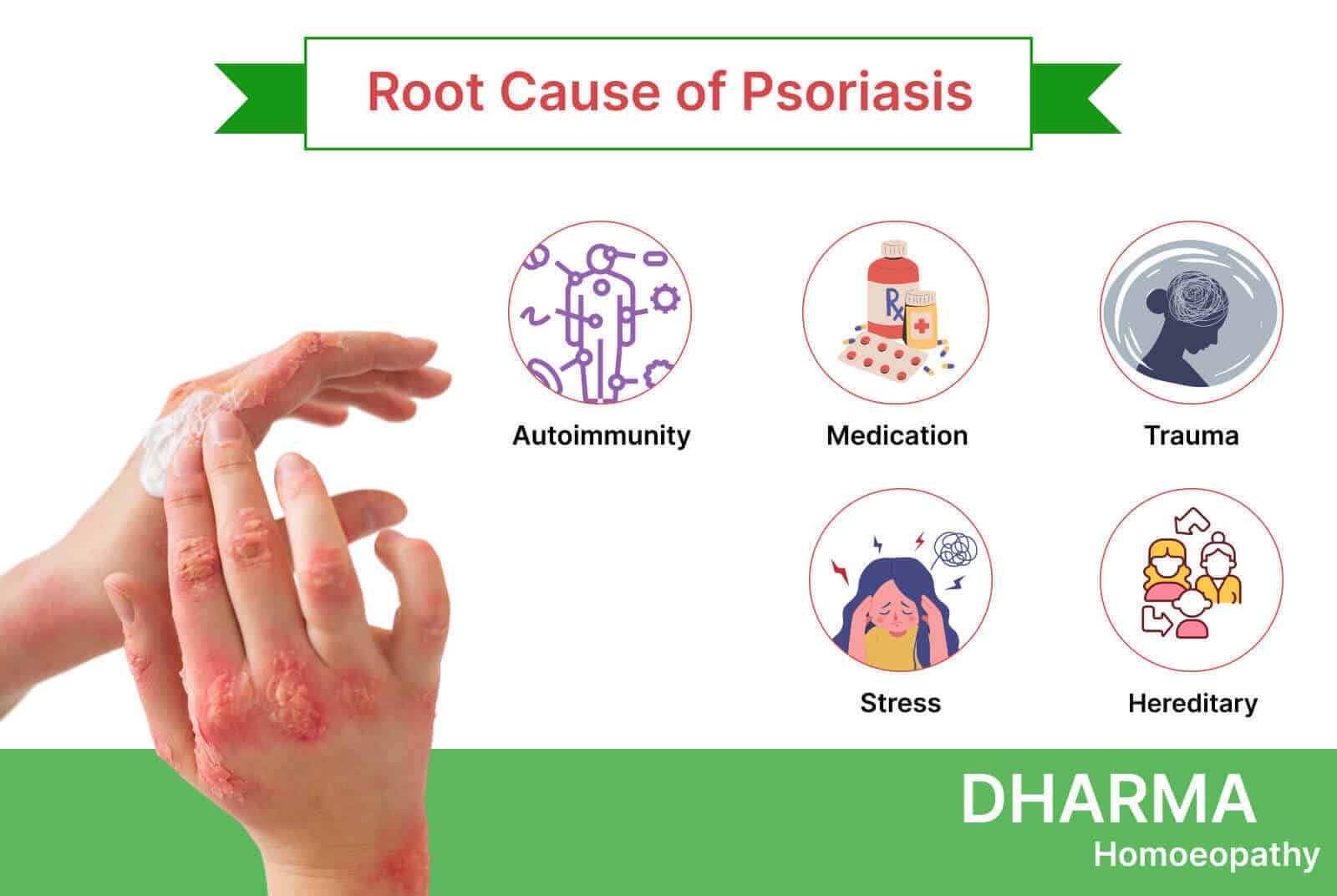 Root-Cause-of-Psoriasis