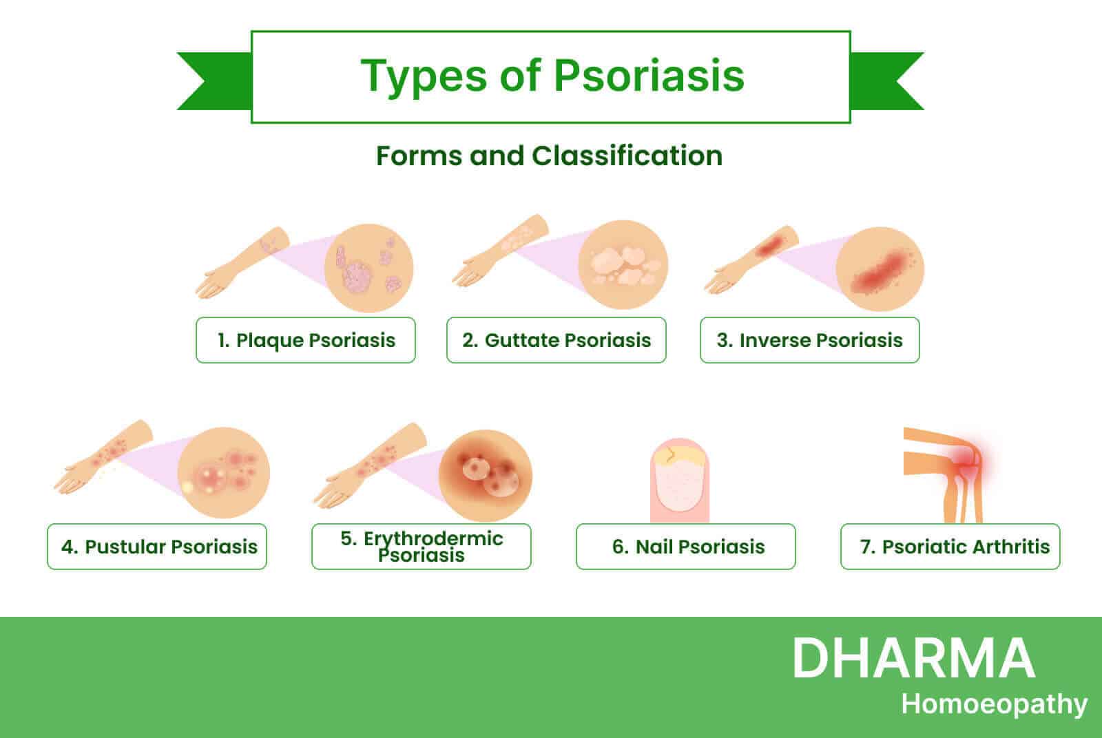types-of-Psoriasis